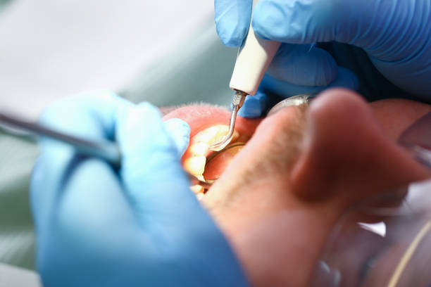 Best Emergency Root Canal Treatment in Sunnyvale, CA